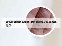 烫伤后白斑怎么处理 烫伤后形成了白斑怎么治疗