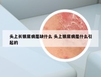 头上长银屑病是缺什么 头上银屑病是什么引起的