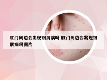 肛门周边会出现银屑病吗 肛门周边会出现银屑病吗图片