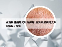 点滴银屑病烤光以后痒痒 点滴银屑病烤光以后痒痒正常吗