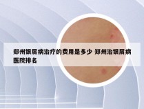 郑州银屑病治疗的费用是多少 郑州治银屑病医院排名