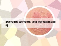 老顽皮治癣后会反弹吗 老顽皮治癣后会反弹吗