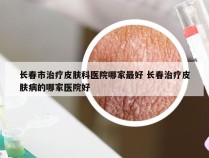 长春市治疗皮肤科医院哪家最好 长春治疗皮肤病的哪家医院好