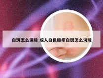 白斑怎么消除 成人白色糠疹白斑怎么消除