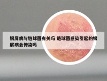 银屑病与链球菌有关吗 链球菌感染引起的银屑病会传染吗