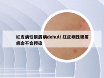 红皮病性银屑病dehuli 红皮病性银屑病会不会传染