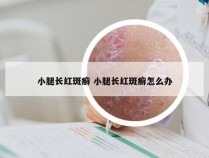 小腿长红斑癣 小腿长红斑癣怎么办