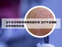 治牛皮生物制剂有哪些副作用 治疗牛皮病癣的生物制剂价格