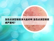 急性点滴型银屑多久能好啊 急性点滴型银屑病严重吗?