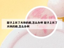 腿子上长了大块的癣,怎么办啊 腿子上长了大块的癣,怎么办啊