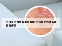 小孩身上为什么周围有癣 小孩身上为什么周围有癣呢