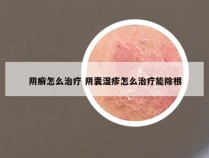 阴癣怎么治疗 阴囊湿疹怎么治疗能除根