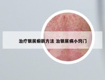 治疗银屑癣新方法 治银屑病小窍门