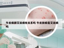 牛皮癣跟艾滋病有关系吗 牛皮肤癣是艾滋病吗