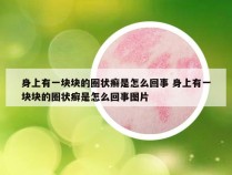 身上有一块块的圈状癣是怎么回事 身上有一块块的圈状癣是怎么回事图片