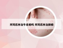 阿司匹林治牛皮癣吗 阿司匹林治脚癣