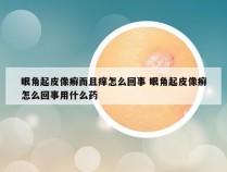 眼角起皮像癣而且痒怎么回事 眼角起皮像癣怎么回事用什么药