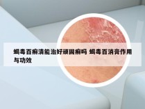 蝎毒百癣清能治好顽固癣吗 蝎毒百消膏作用与功效