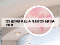 理发遇到银屑病怎么办 理发店理发会传染头皮屑吗