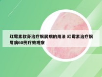 红霉素软膏治疗银屑病的用法 红霉素治疗银屑病60例疗效观察