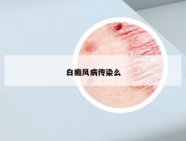 白癜风病传染么