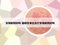 生物制剂好吗 强制性脊柱炎打生物制剂好吗