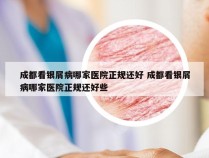 成都看银屑病哪家医院正规还好 成都看银屑病哪家医院正规还好些