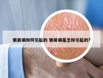 银屑病如何引起的 银屑病是怎样引起的?