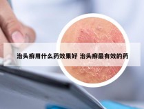 治头癣用什么药效果好 治头癣最有效的药