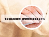 银屑病影响求职吗 银屑病影响事业编体检吗