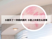 小腿长了一块癣的图片 小腿上长癣怎么回事