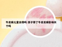 牛皮癣儿童会得吗 孩子得了牛皮皮癣影响长个吗