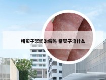 楮实子浆能治癣吗 楮实子治什么