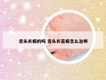 舌头长癣的吗 舌头长苔癣怎么治啊