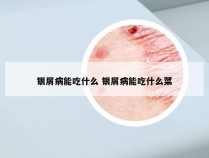 银屑病能吃什么 银屑病能吃什么菜