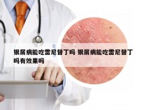 银屑病能吃雷尼替丁吗 银屑病能吃雷尼替丁吗有效果吗