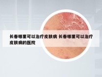 长春哪里可以治疗皮肤病 长春哪里可以治疗皮肤病的医院