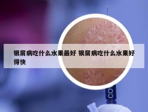 银屑病吃什么水果最好 银屑病吃什么水果好得快