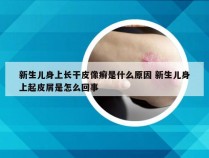 新生儿身上长干皮像癣是什么原因 新生儿身上起皮屑是怎么回事