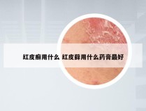 红皮癣用什么 红皮藓用什么药膏最好