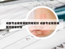 成都专业银屑病医院哪家好 成都专业银屑病医院哪家好些