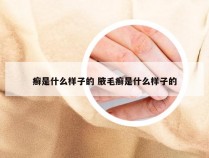 癣是什么样子的 腋毛癣是什么样子的