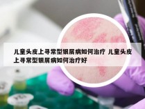 儿童头皮上寻常型银屑病如何治疗 儿童头皮上寻常型银屑病如何治疗好