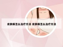 皮肤癣怎么治疗方法 皮肤癣怎么治疗方法