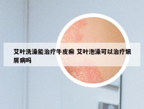 艾叶洗澡能治疗牛皮癣 艾叶泡澡可以治疗银屑病吗