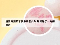 后背突然长了很多癣怎么办 后背起了一片癣图片