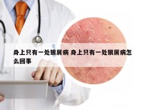 身上只有一处银屑病 身上只有一处银屑病怎么回事