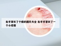 右手掌长了个癣的图片大全 右手手掌长了一个小疙瘩