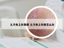 儿子身上长像癣 儿子身上长癣怎么办