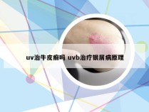 uv治牛皮癣吗 uvb治疗银屑病原理